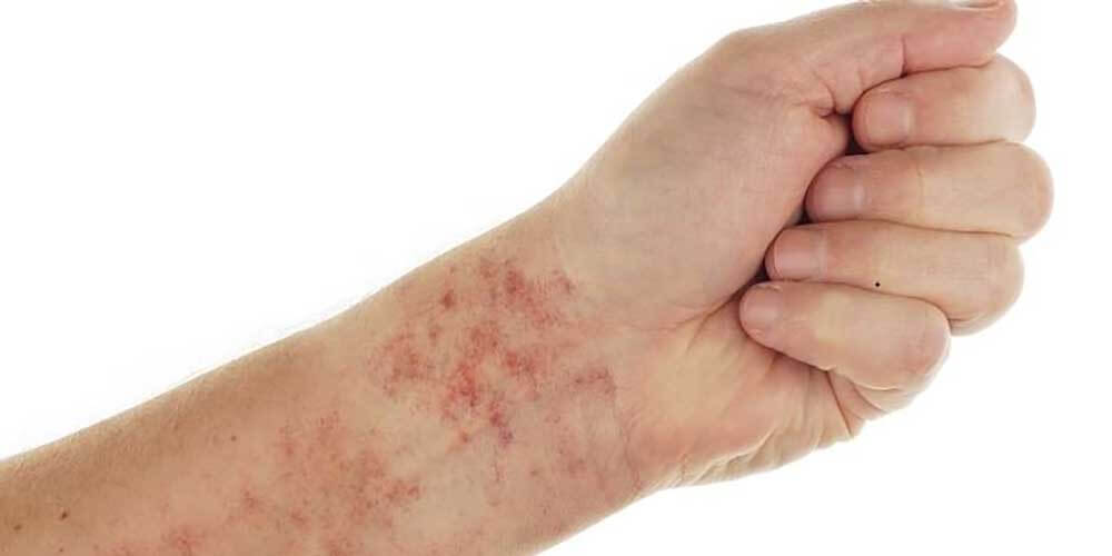 Skin Rash And Sexually Transmitted Diseases