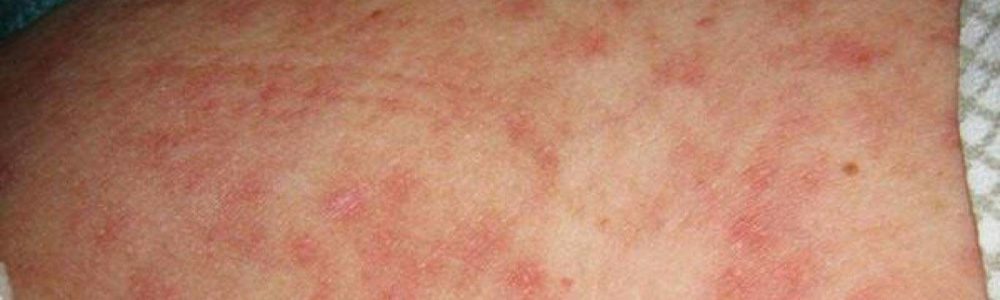 Skin Rash and Sexually Transmitted Diseases: Symptoms, Types, and