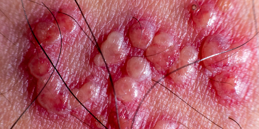 painful bumps on buttocks cheek painful bumps on buttocks cheek