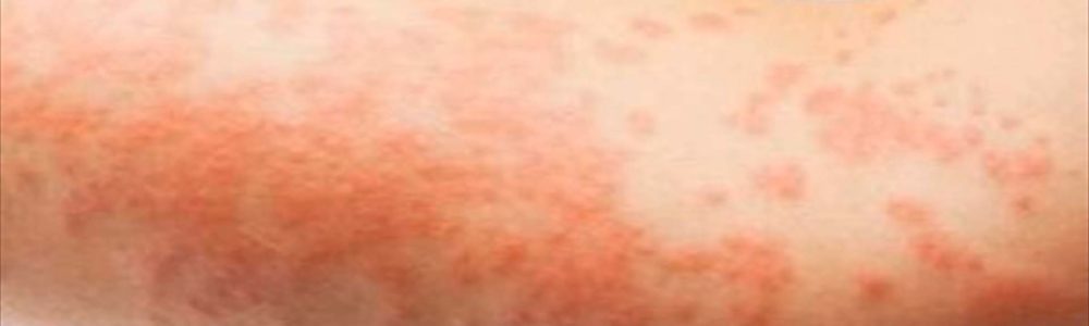Skin Rash and Sexually Transmitted Diseases: Symptoms, Types, and  Differentiation