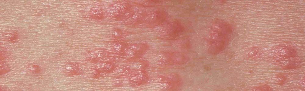Chlamydia Rash On Body Chlamydia Sympt mes Femme LINIZD Chlamydia Rash On Body Chlamydia Sympt mes Femme LINIZD