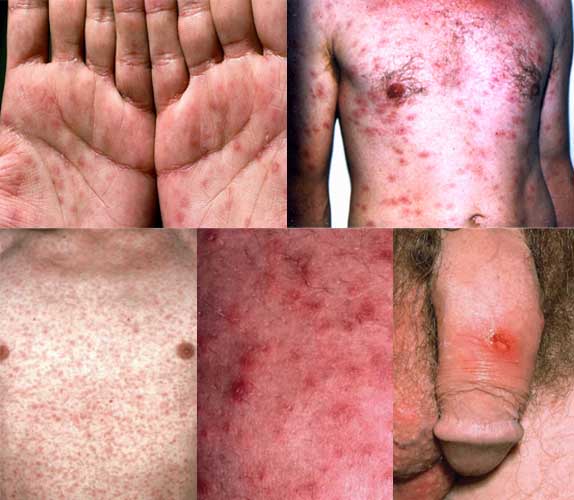 Images of sexually transmitted diseases