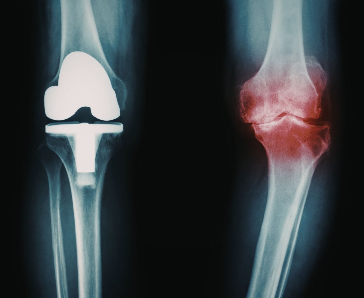 STD and Knee Pain? What Reactive Arthritis Really Feels Like
