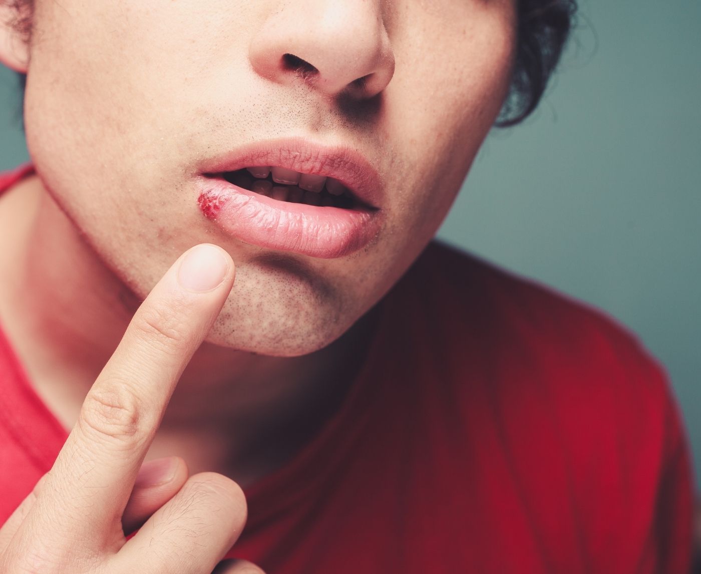 Herpes, Syphilis, or Nothing? The Mouth Sores You Can’t Ignore