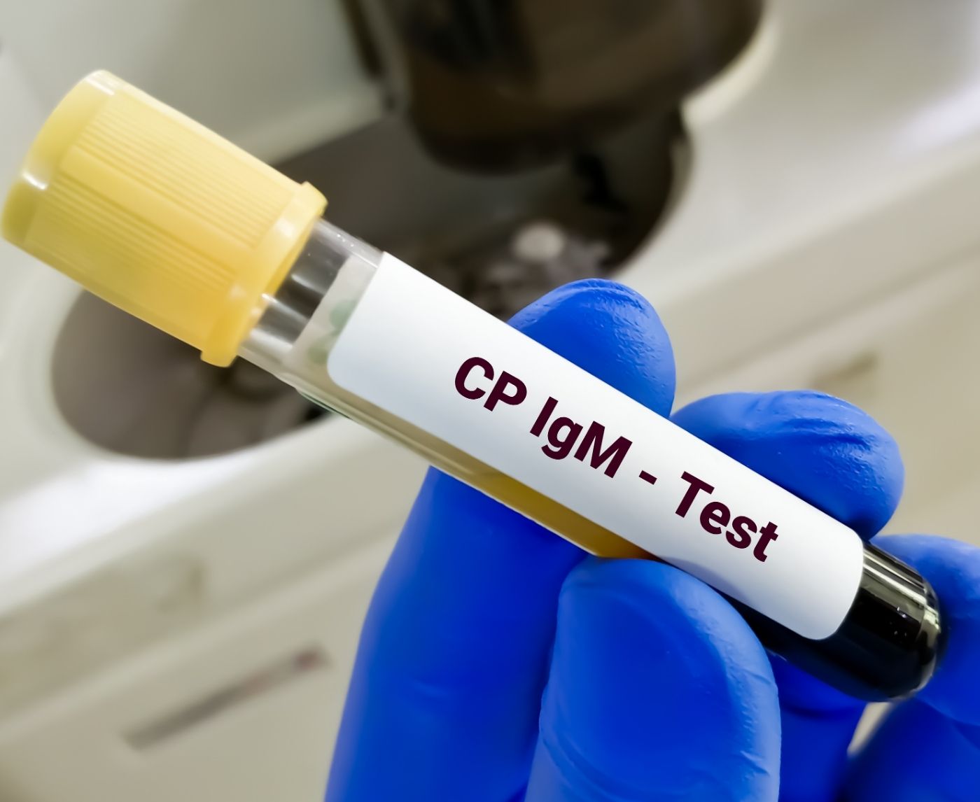 Who Should Get Tested for Chlamydia? A Real Talk on Risks and Screening