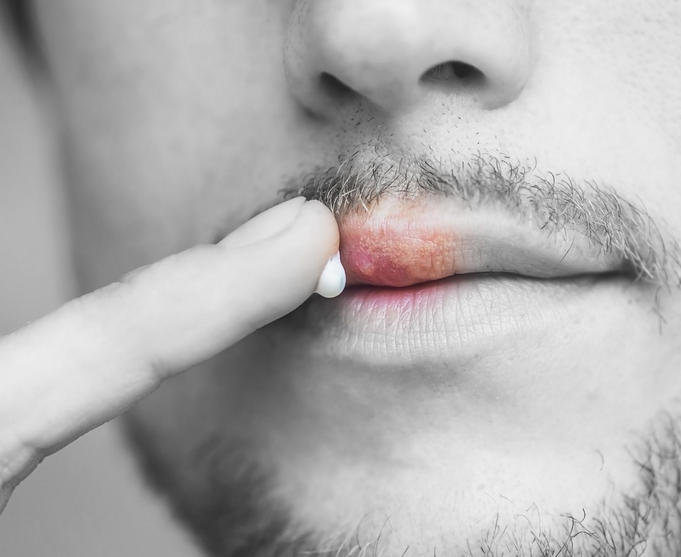 Yes, You Can Give Someone Genital Herpes With a Cold Sore
