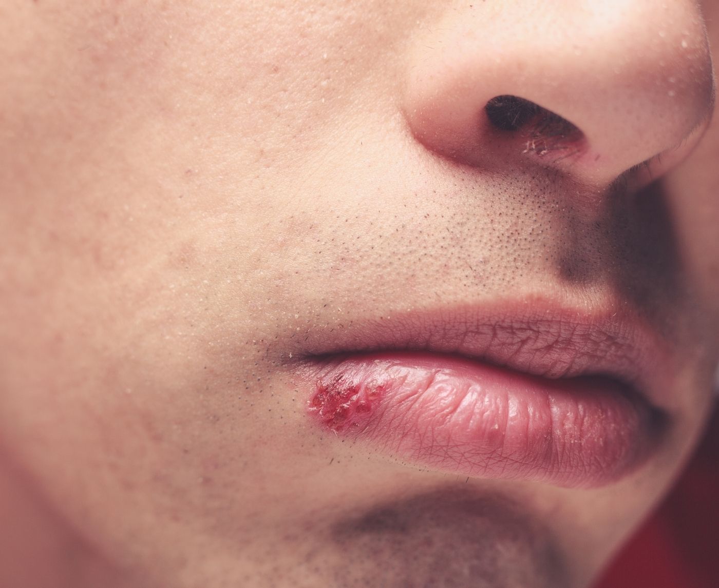 He Had a Cold Sore, Now I Have Genital Herpes