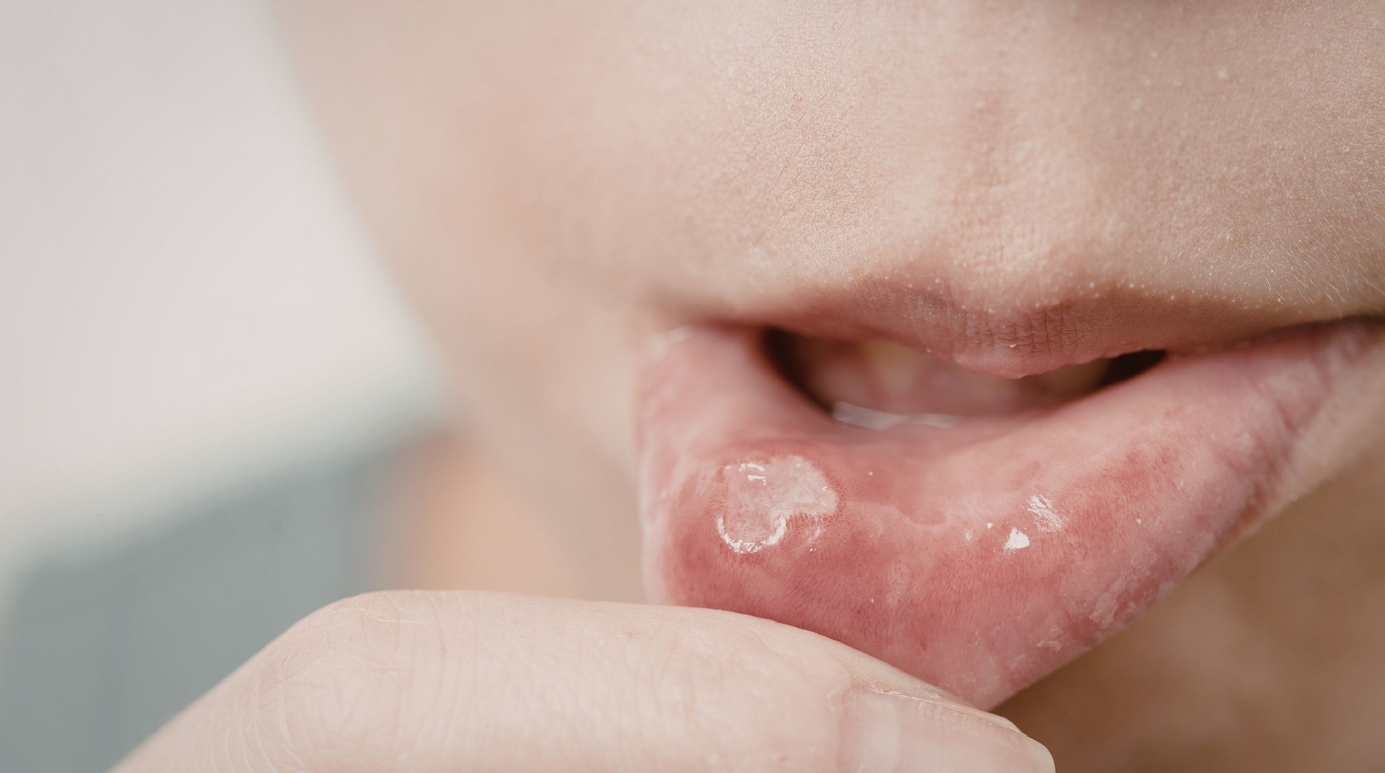 Yes, You Can Give Someone Genital Herpes With a Cold Sore