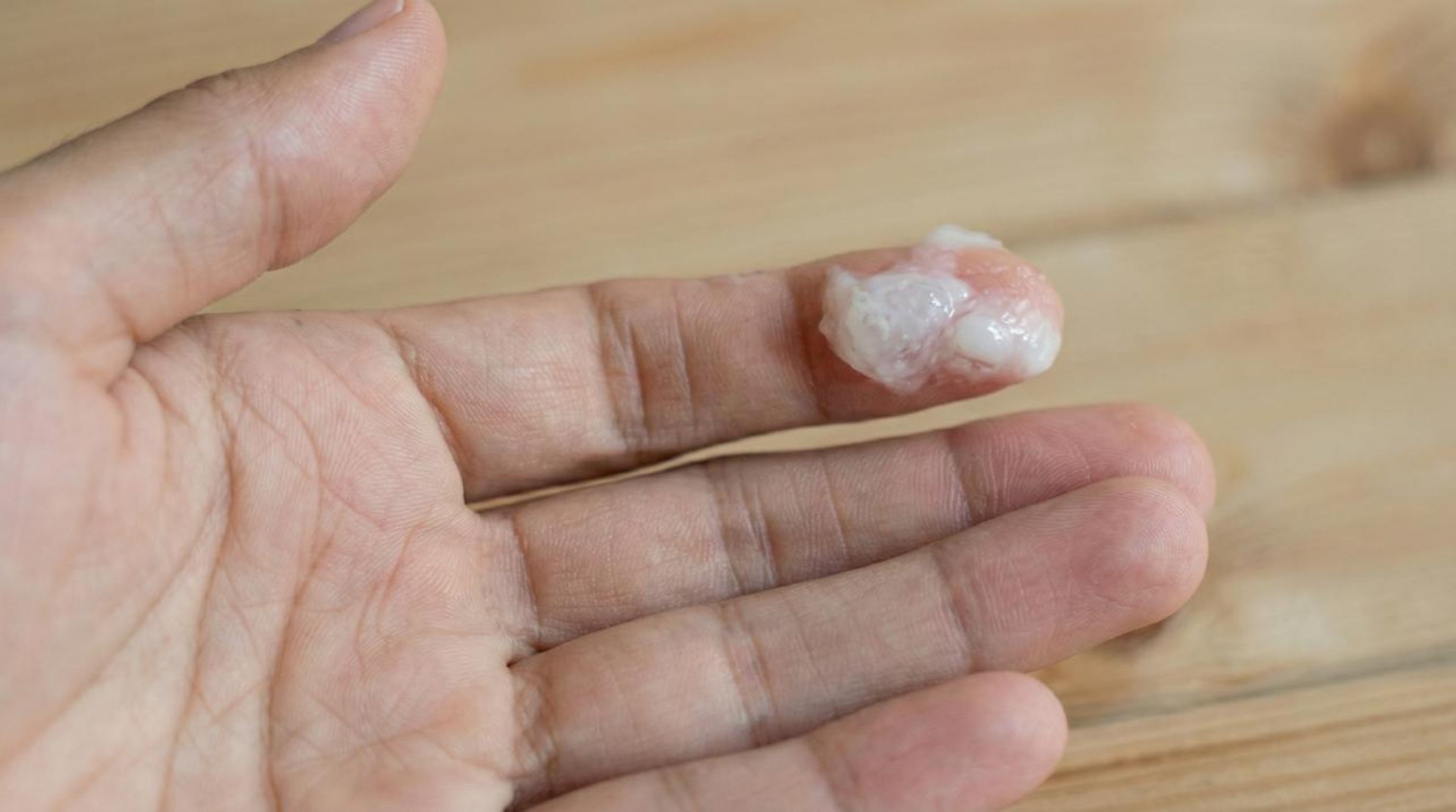 What Does Chlamydia Discharge Look Like? Complete Guide for Men and Women