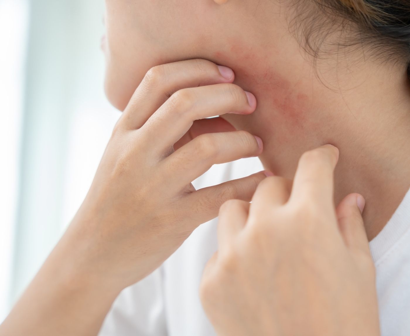 Herpes or Heat Rash? How to Tell What That Red Spot Is