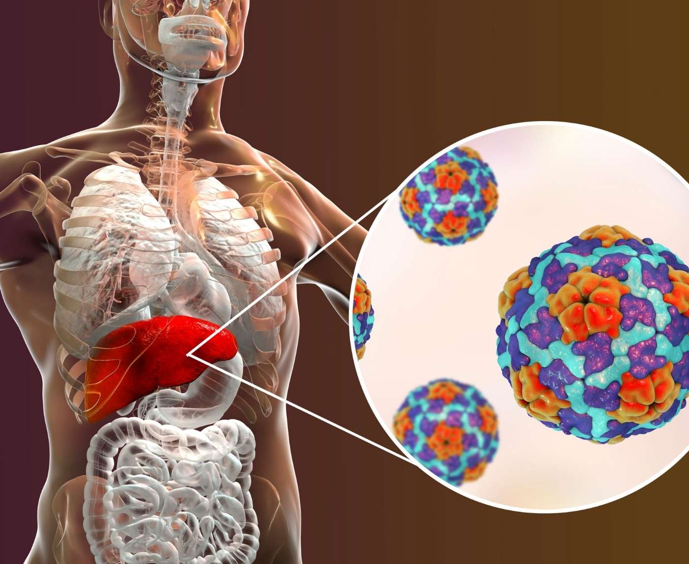 How Hepatitis C Turns Into Cirrhosis Without Warning