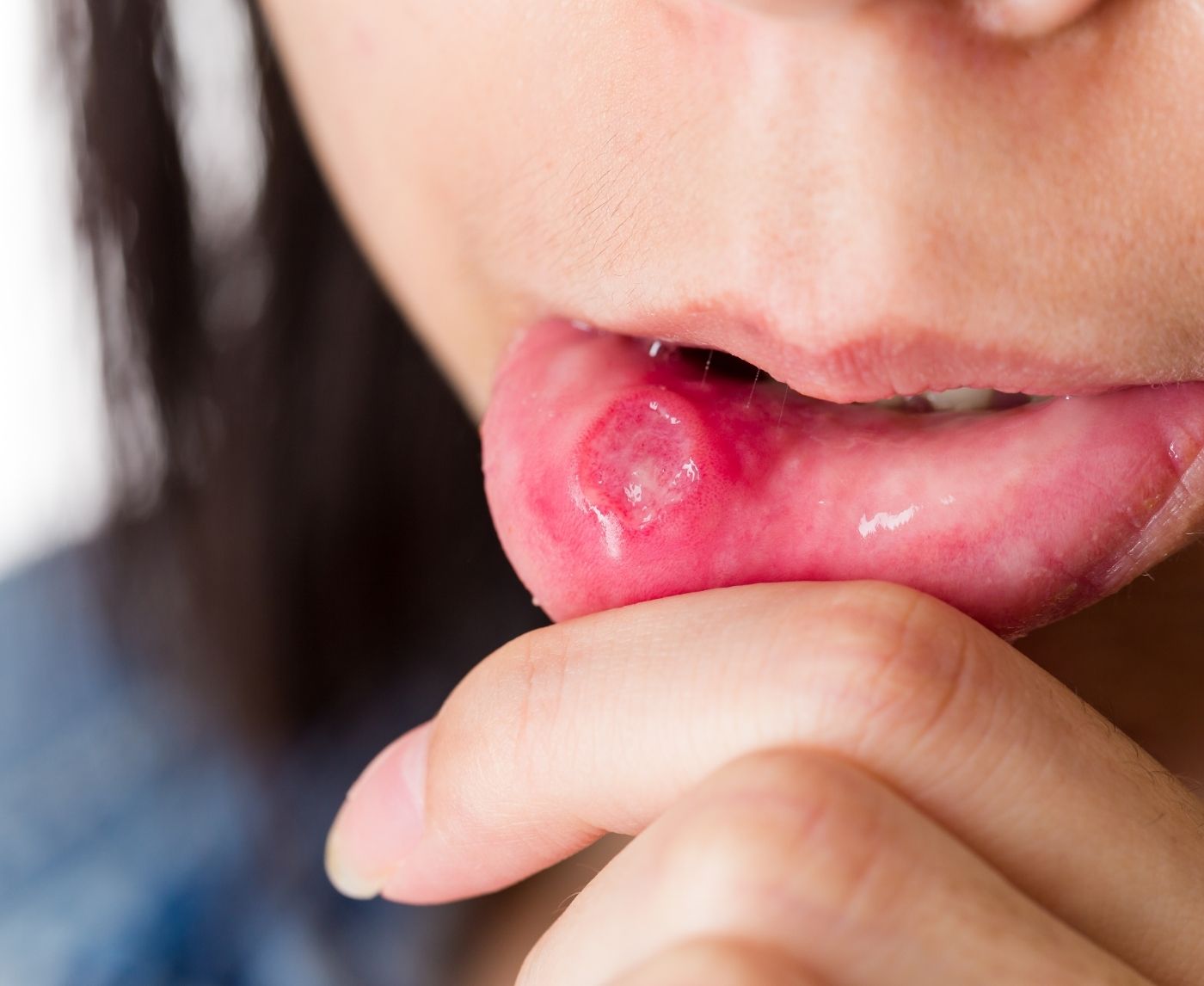 Everyone Has Herpes (They Just Don’t Know It Yet)