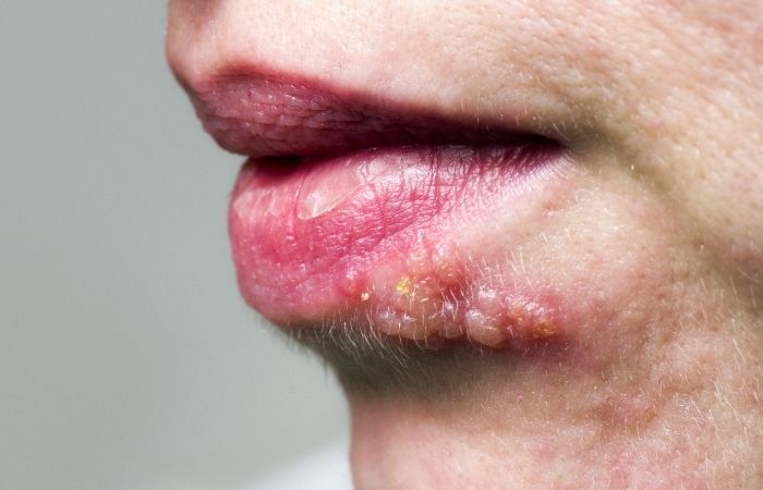 I Didn’t Know I Had Oral Herpes, Until I Passed It On