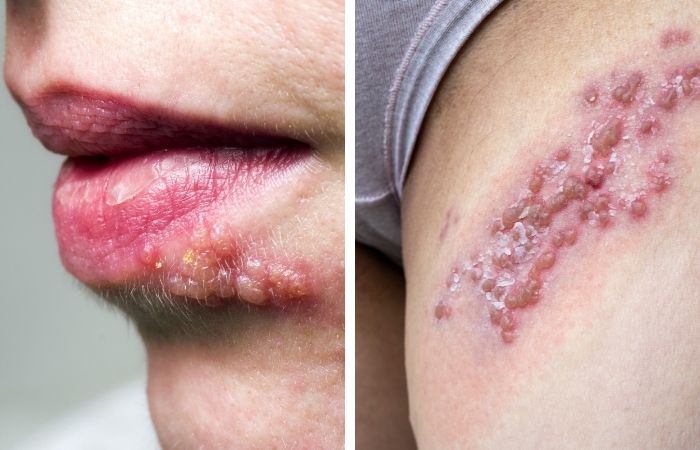 Oral vs. Genital Herpes: What’s the Difference and Does It Matter?