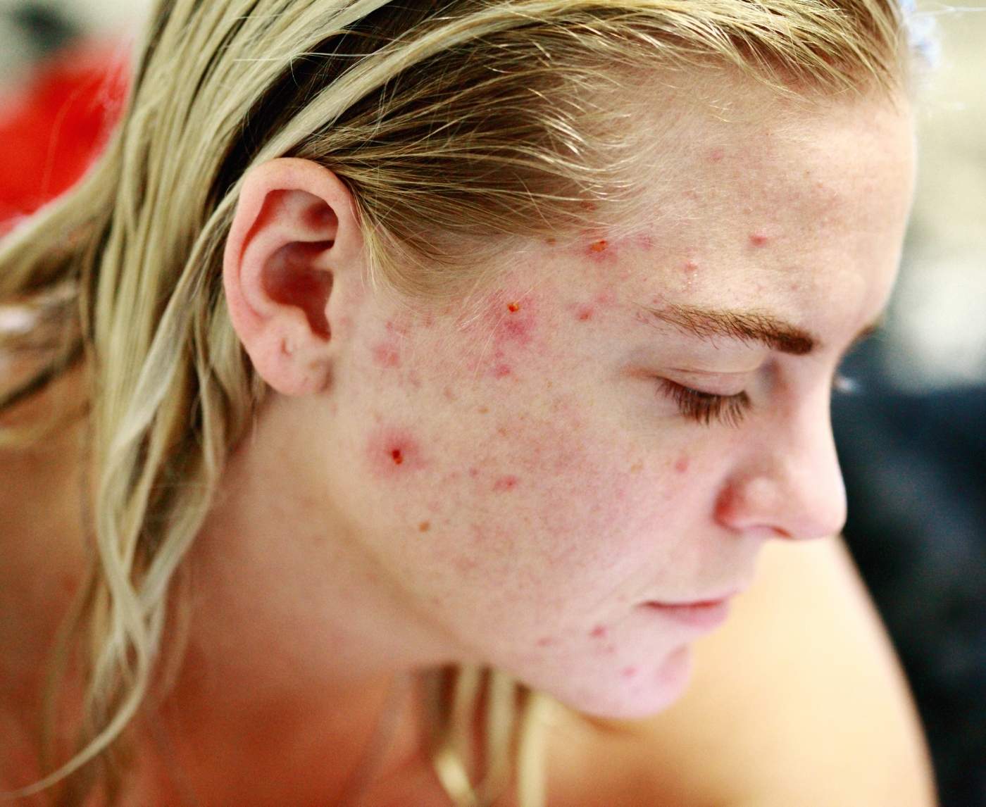 You Might Be Mistaking Herpes for Acne