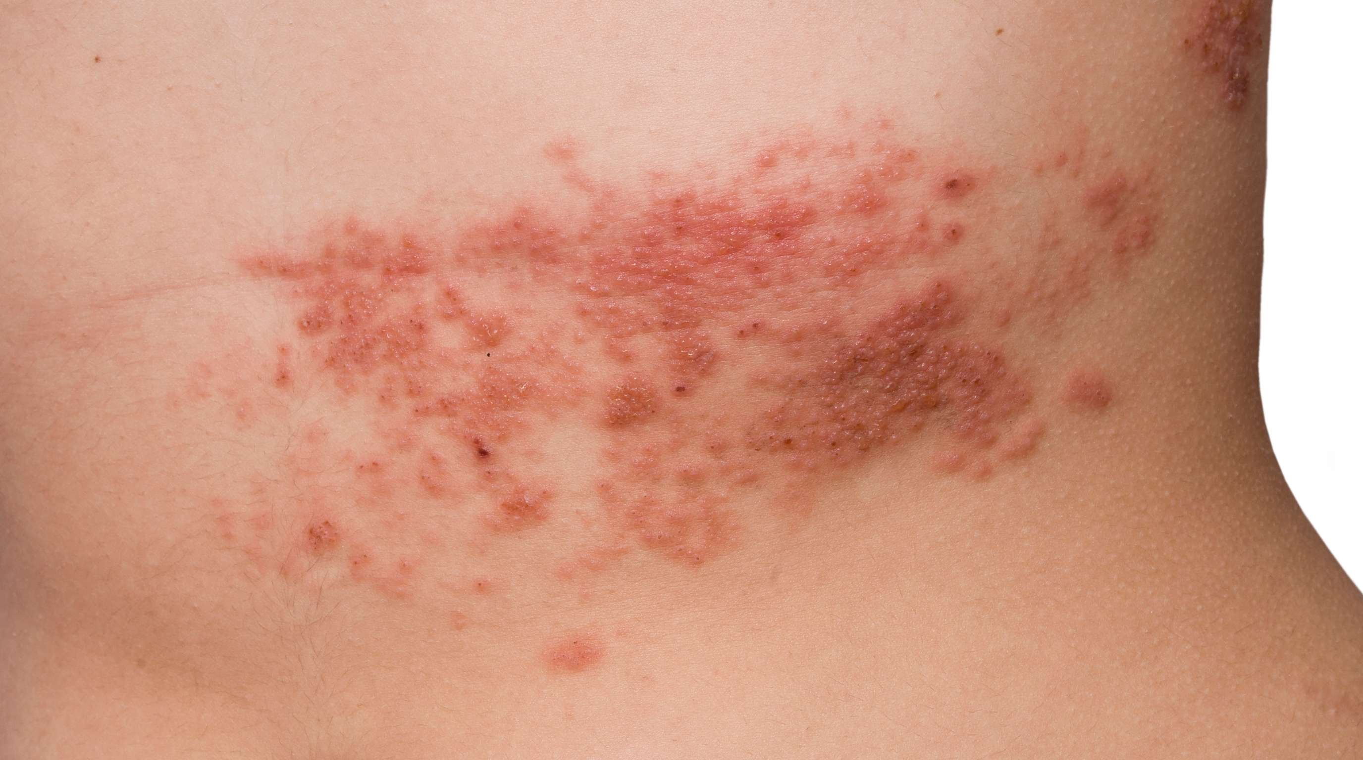 Herpes: What It Actually Is, How It Spreads, How to Test, and What Comes After a Diagnosis