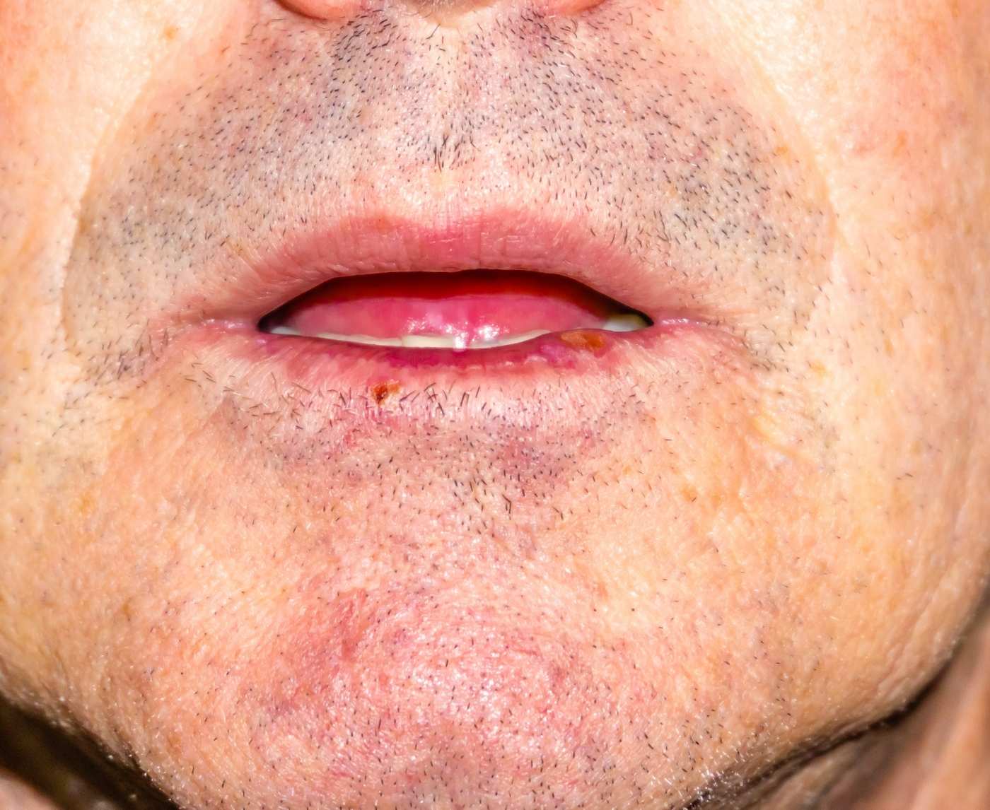 How Oral Herpes Impacts Men