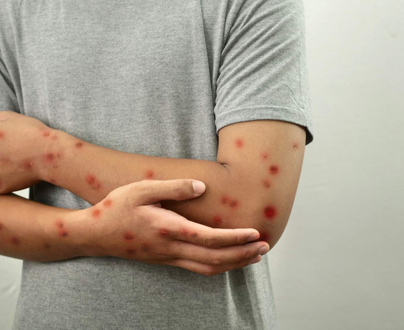 When Monkeypox Looks Like an STI: Key Differences Explained