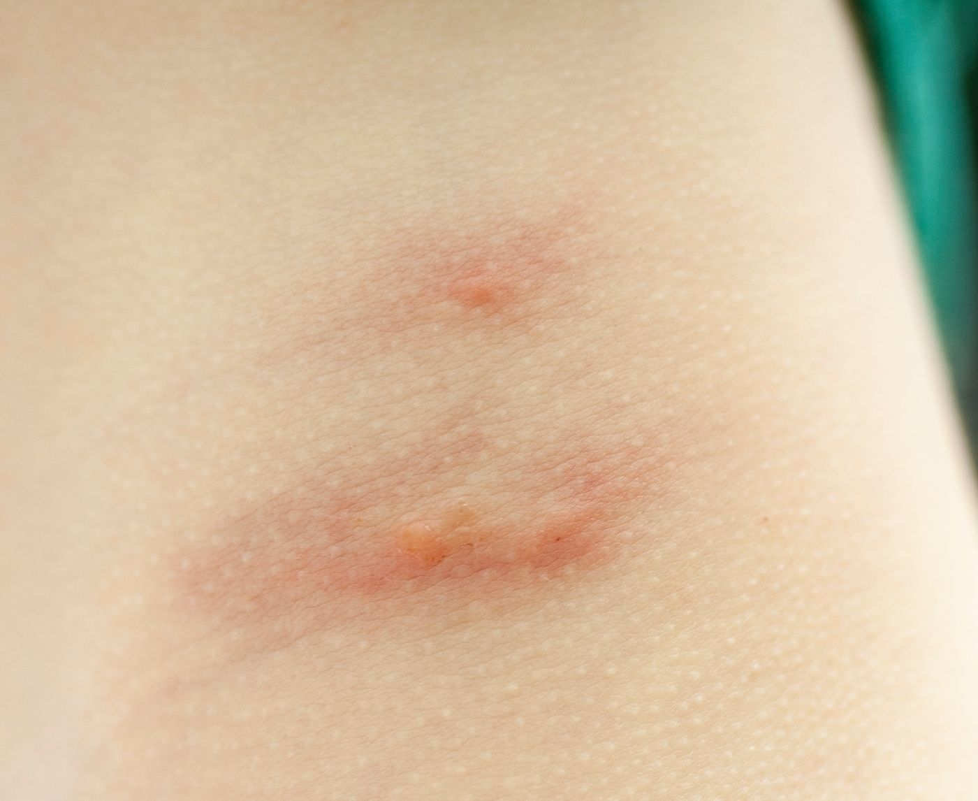 The STD That Pretends to Be a Mosquito Bite: How to Spot Syphilis Sores