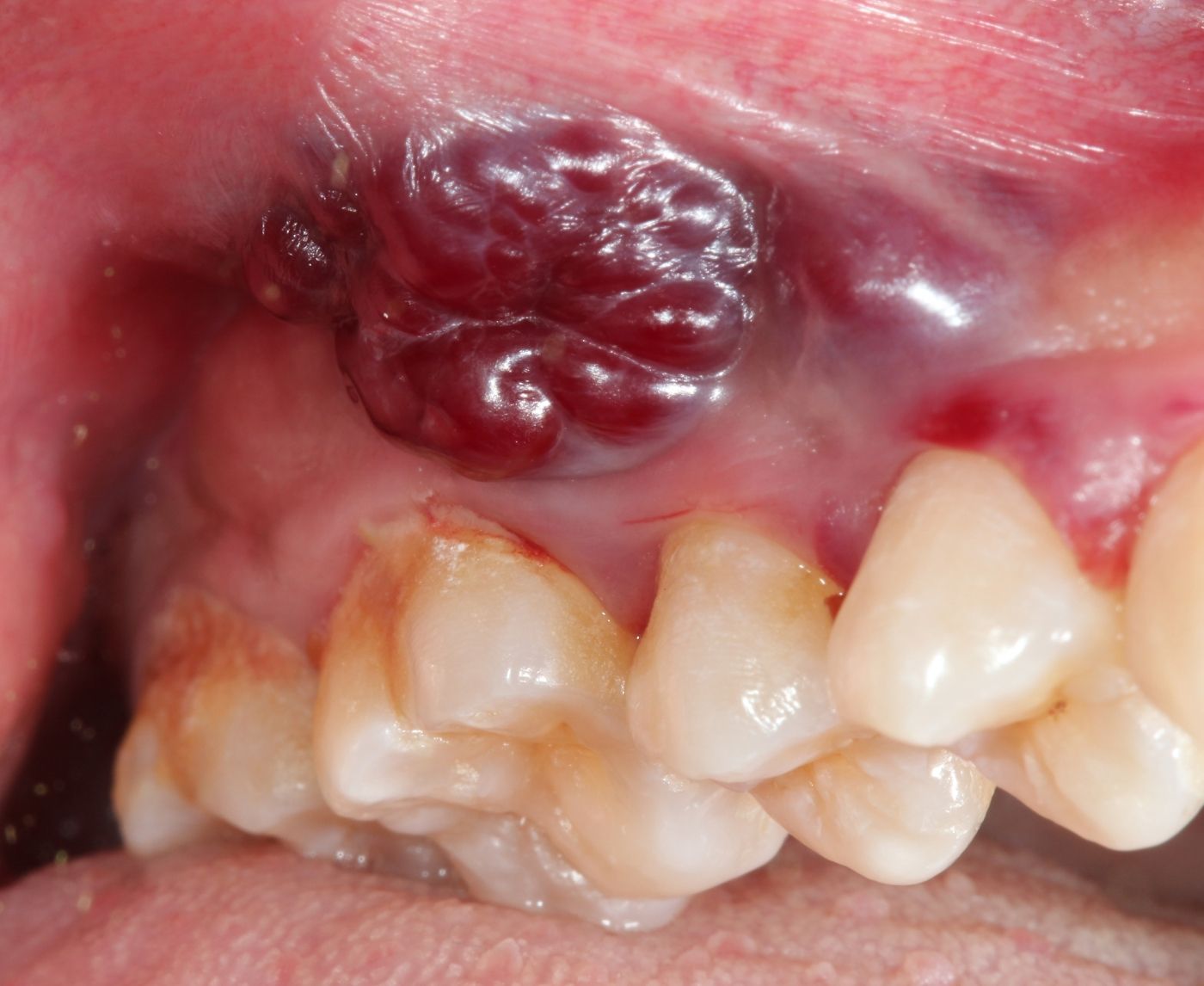 How Risky is Oral Sex? The STD Truth About Spitting and Swallowing