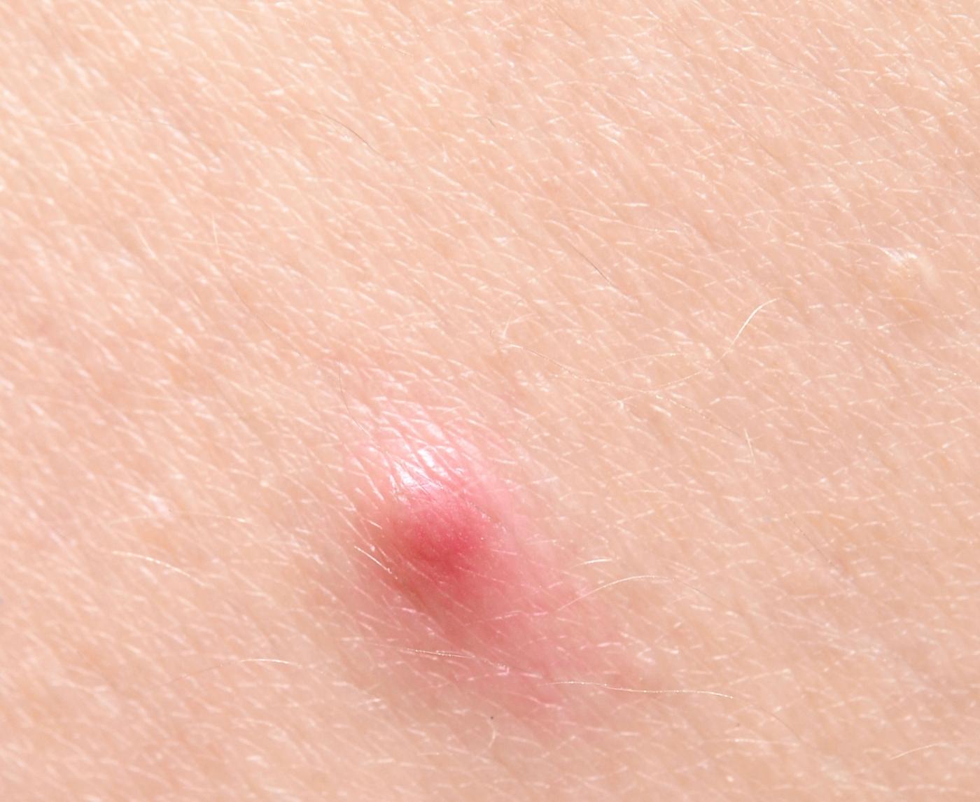 STD Bump, Pimple, or Herpes? How to Spot the Difference