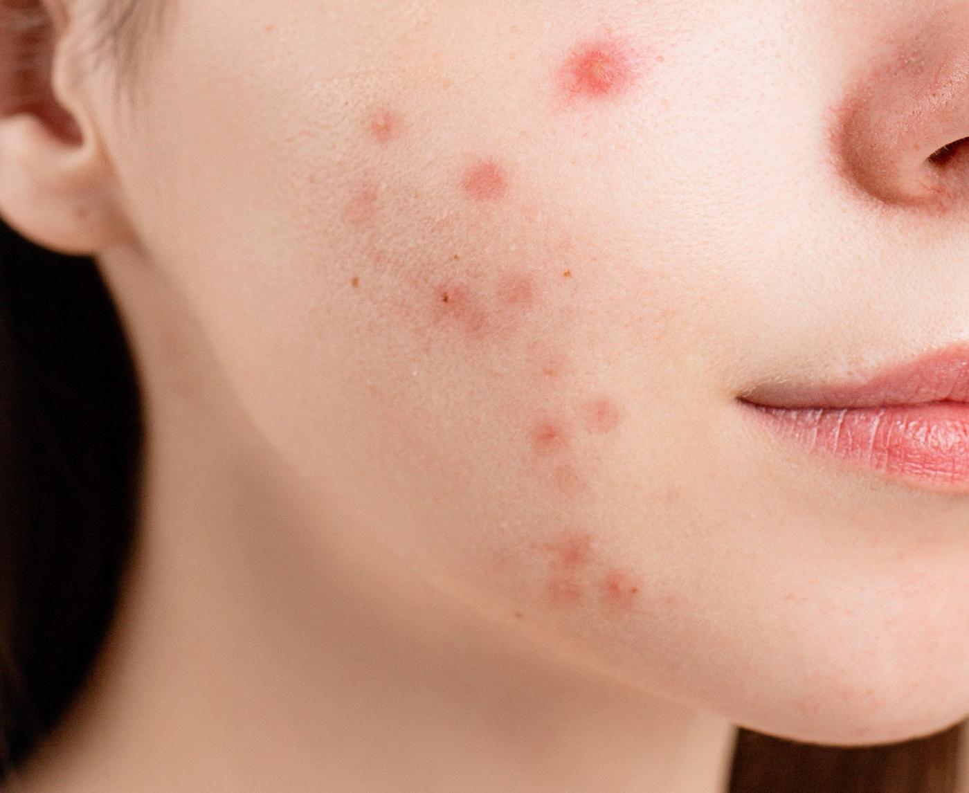 Pimple or Herpes? I Didn’t Know Until It Was Too Late