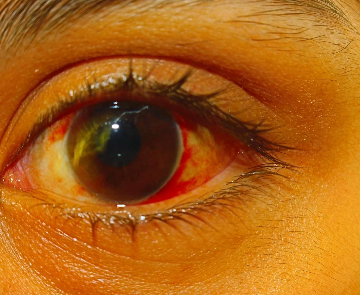The STD That Looks Like Pink Eye But Can Melt Your Cornea