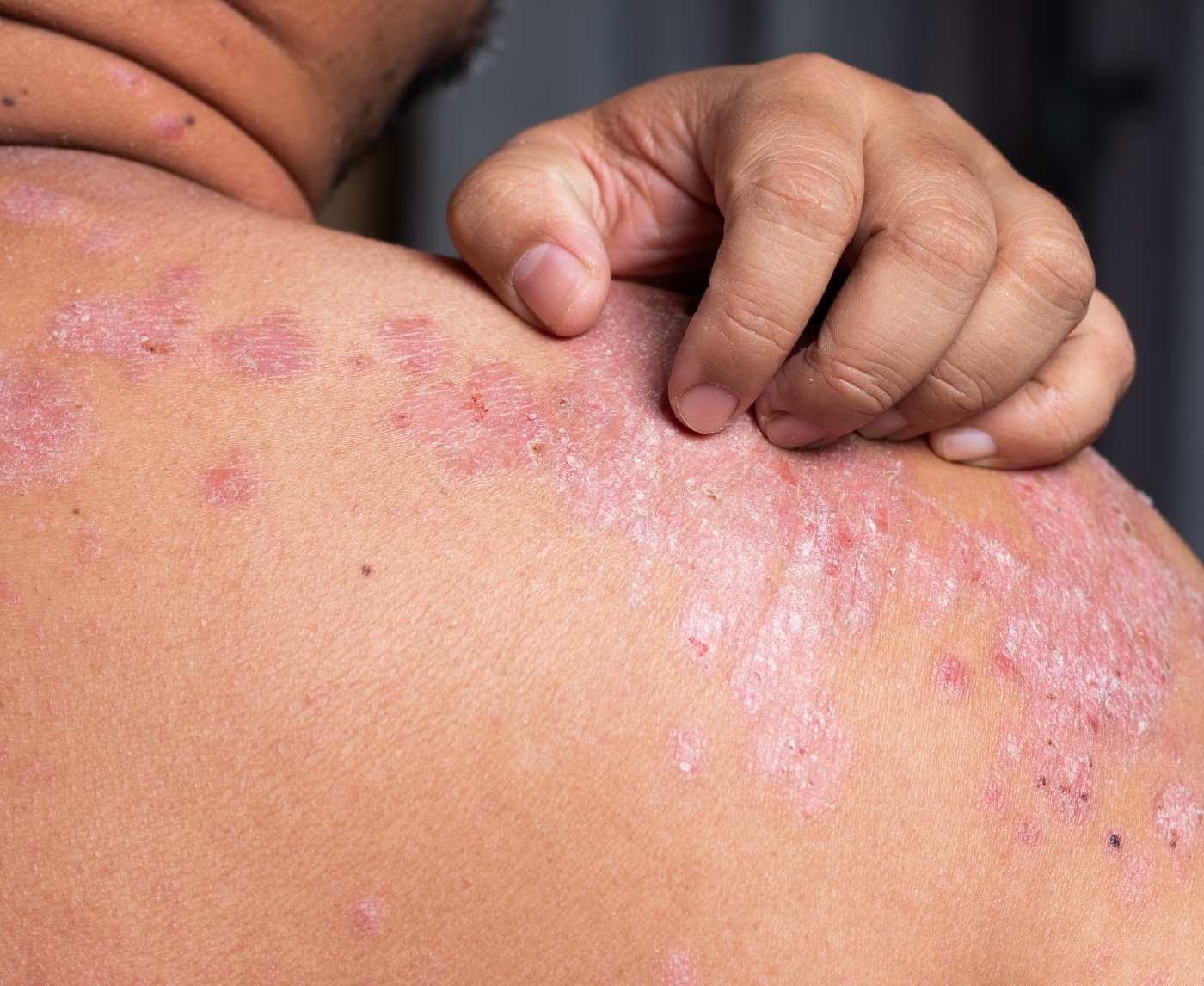 Syphilis Rash vs. Herpes vs. Eczema: What’s Really on Your Skin?