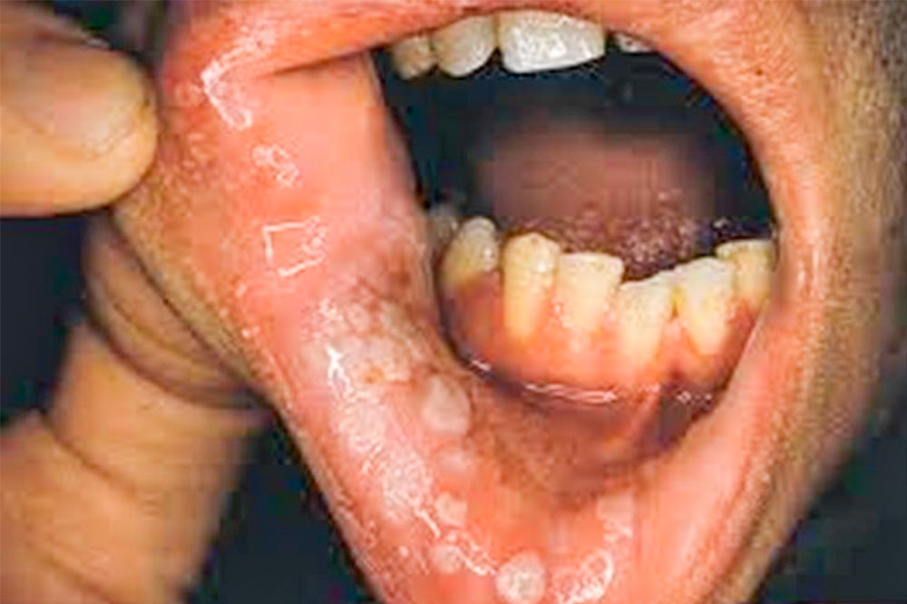 Rimming, Licking, and Lurking STDs: The Oral Risks No One Talks About