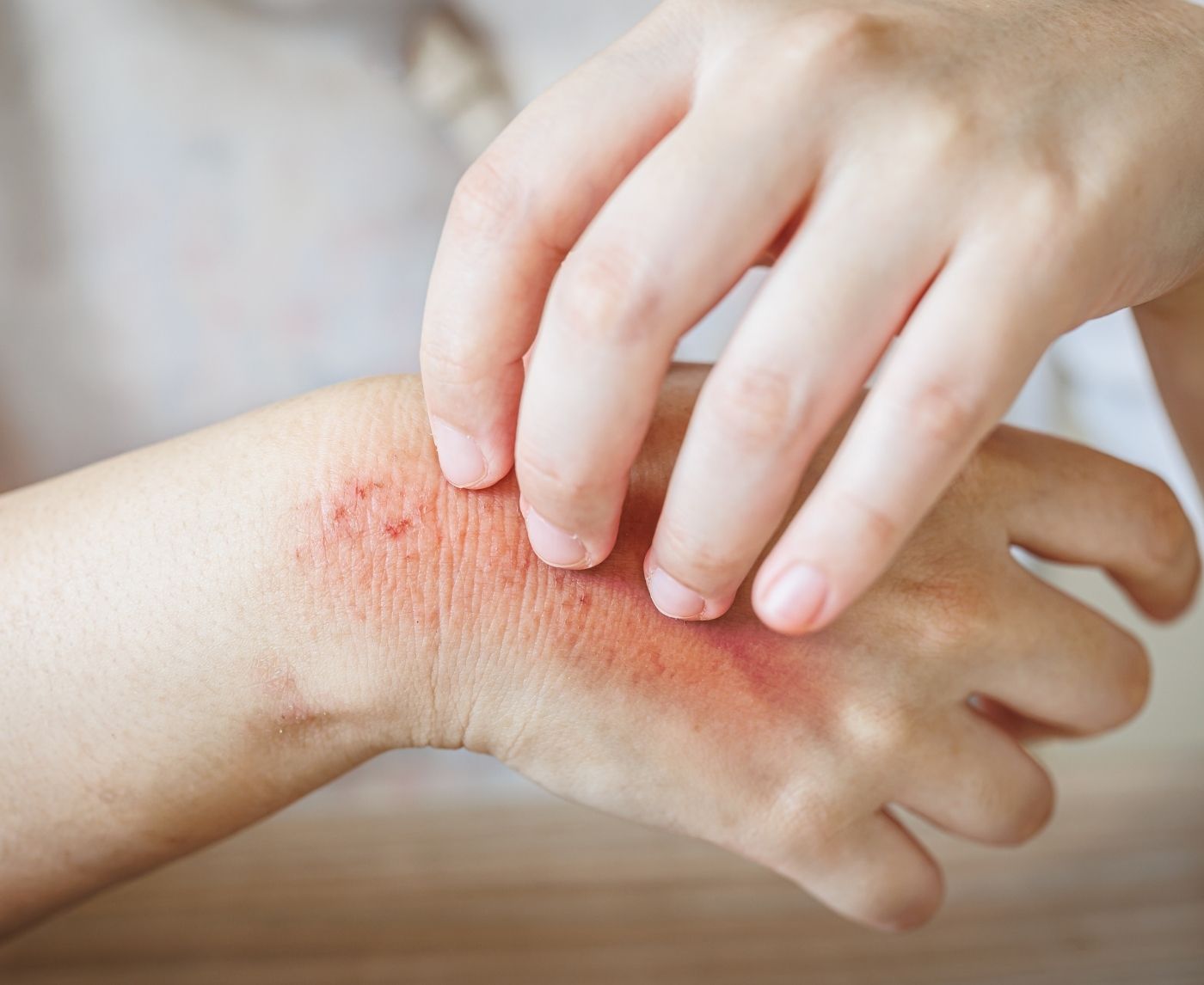 Rash After Sex: STD, Allergy, or Something Else?