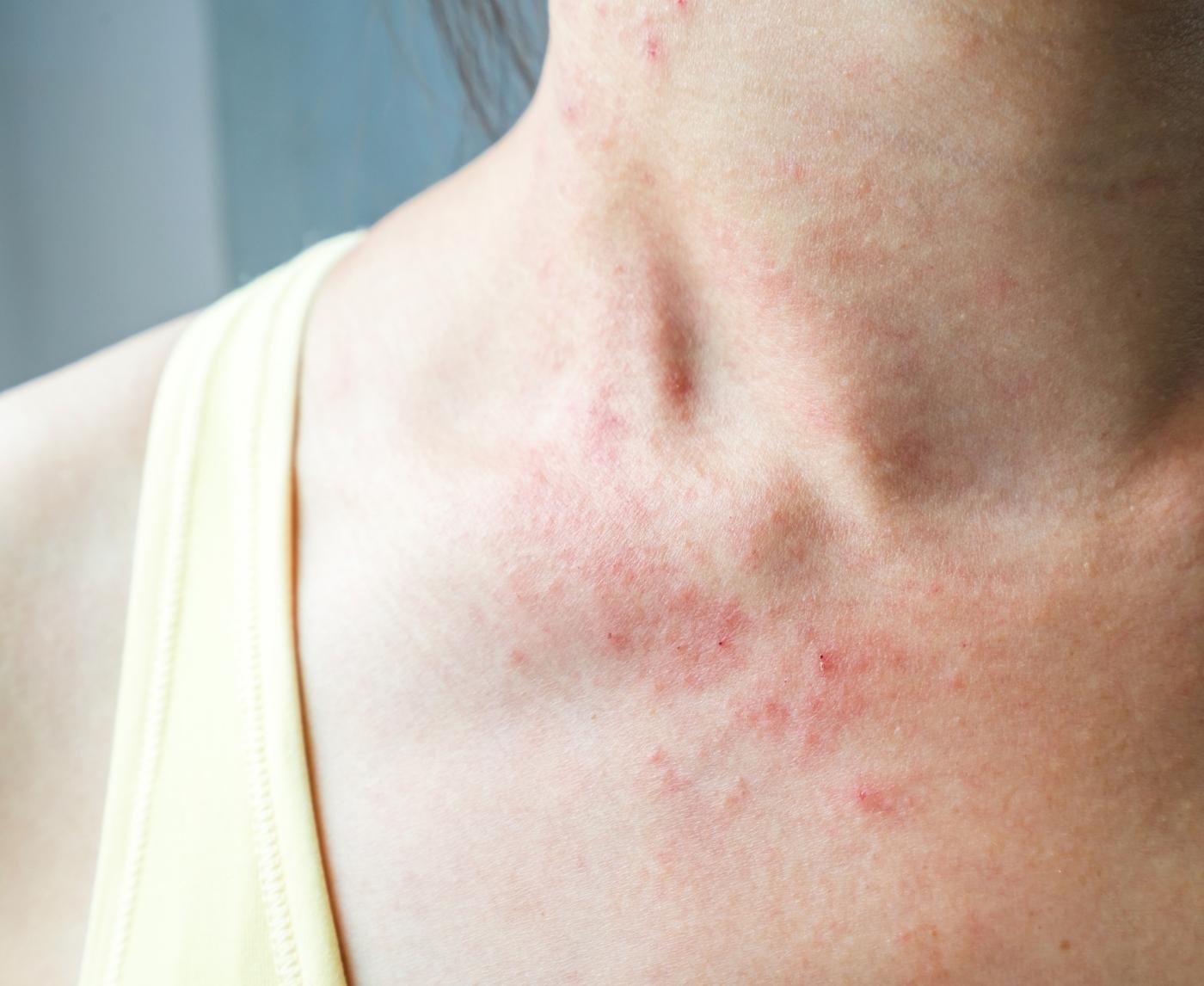 That Rash Might Not Be an Allergy: Signs of Syphilis