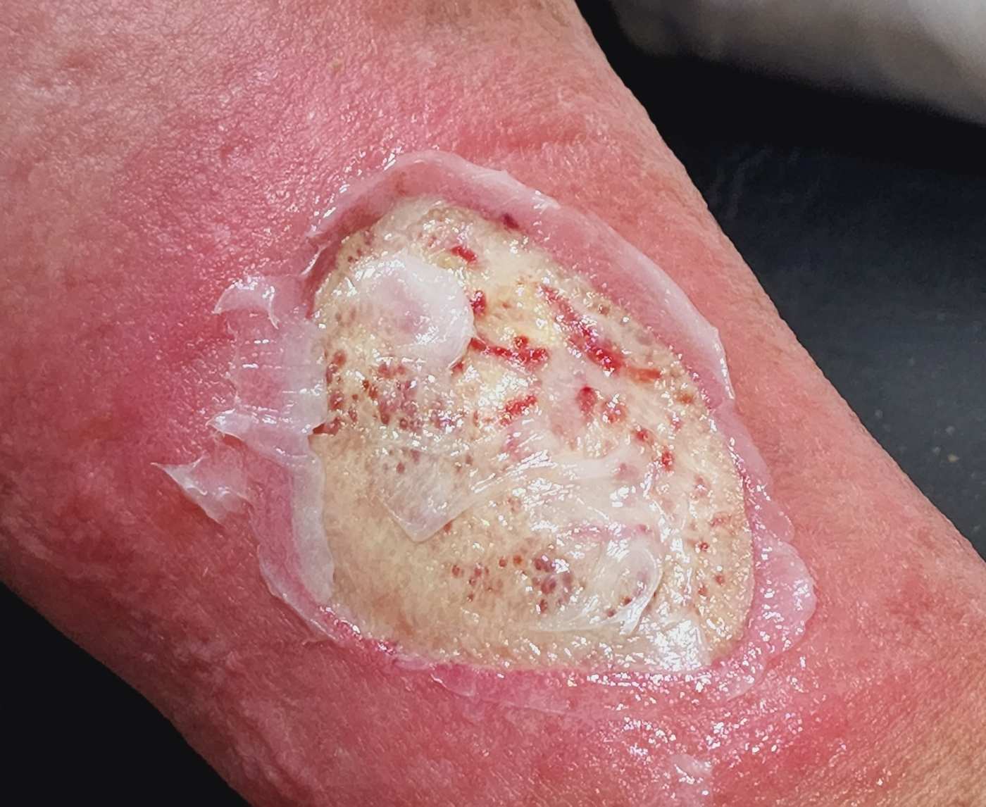 Donovanosis: The Flesh-Eating STD You’ve Probably Never Heard Of