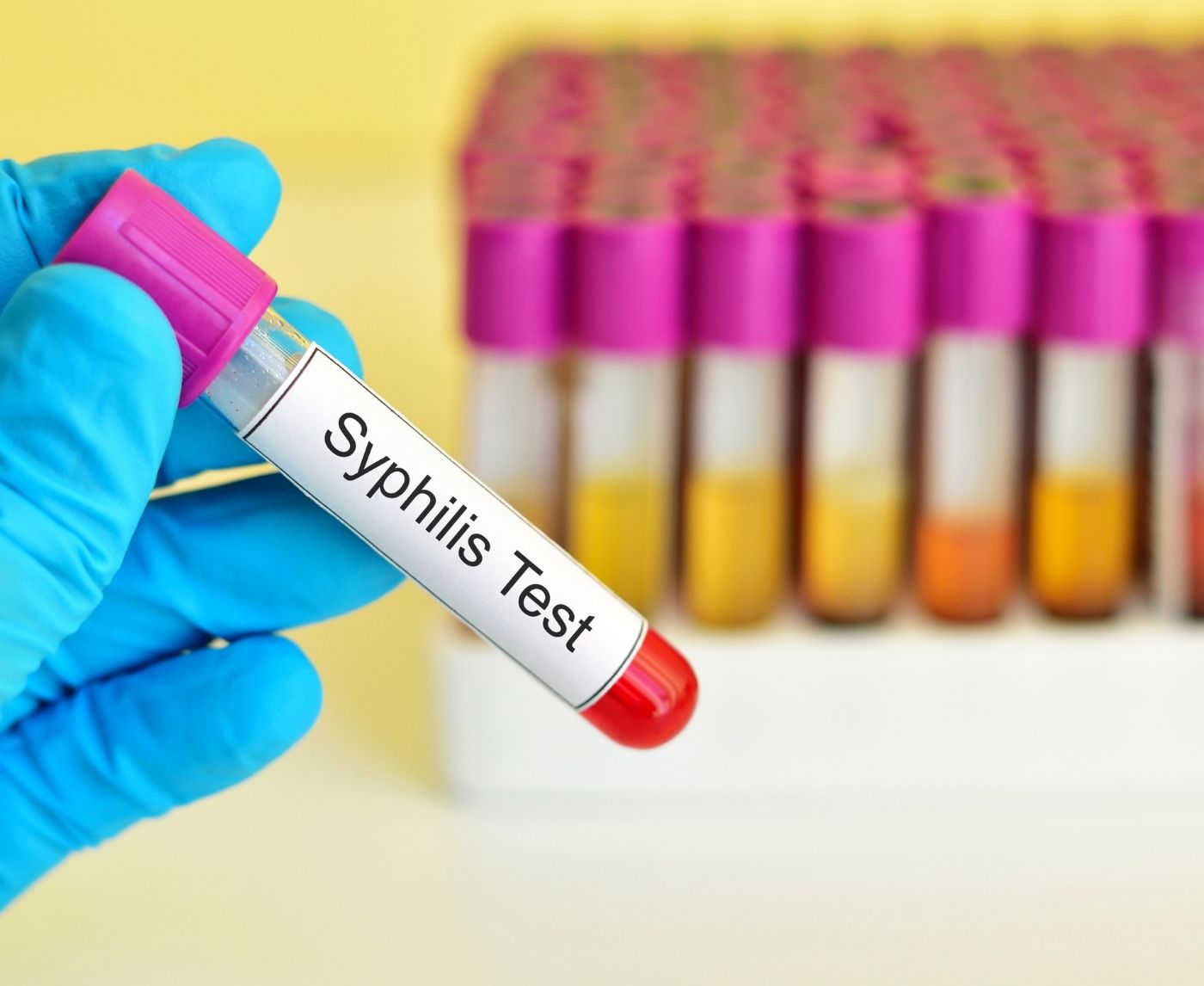 What Happens After a Positive Syphilis Test, And What You Shouldn’t Do
