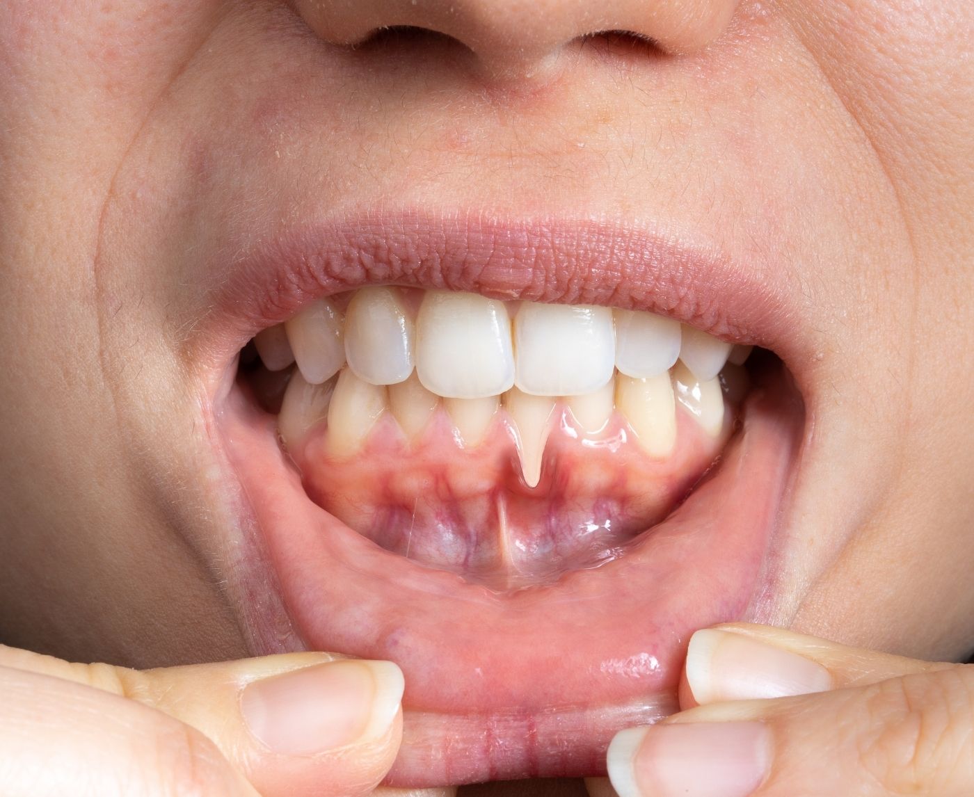  Syphilis in the Mouth: What It Looks Like, Feels Like, and Means