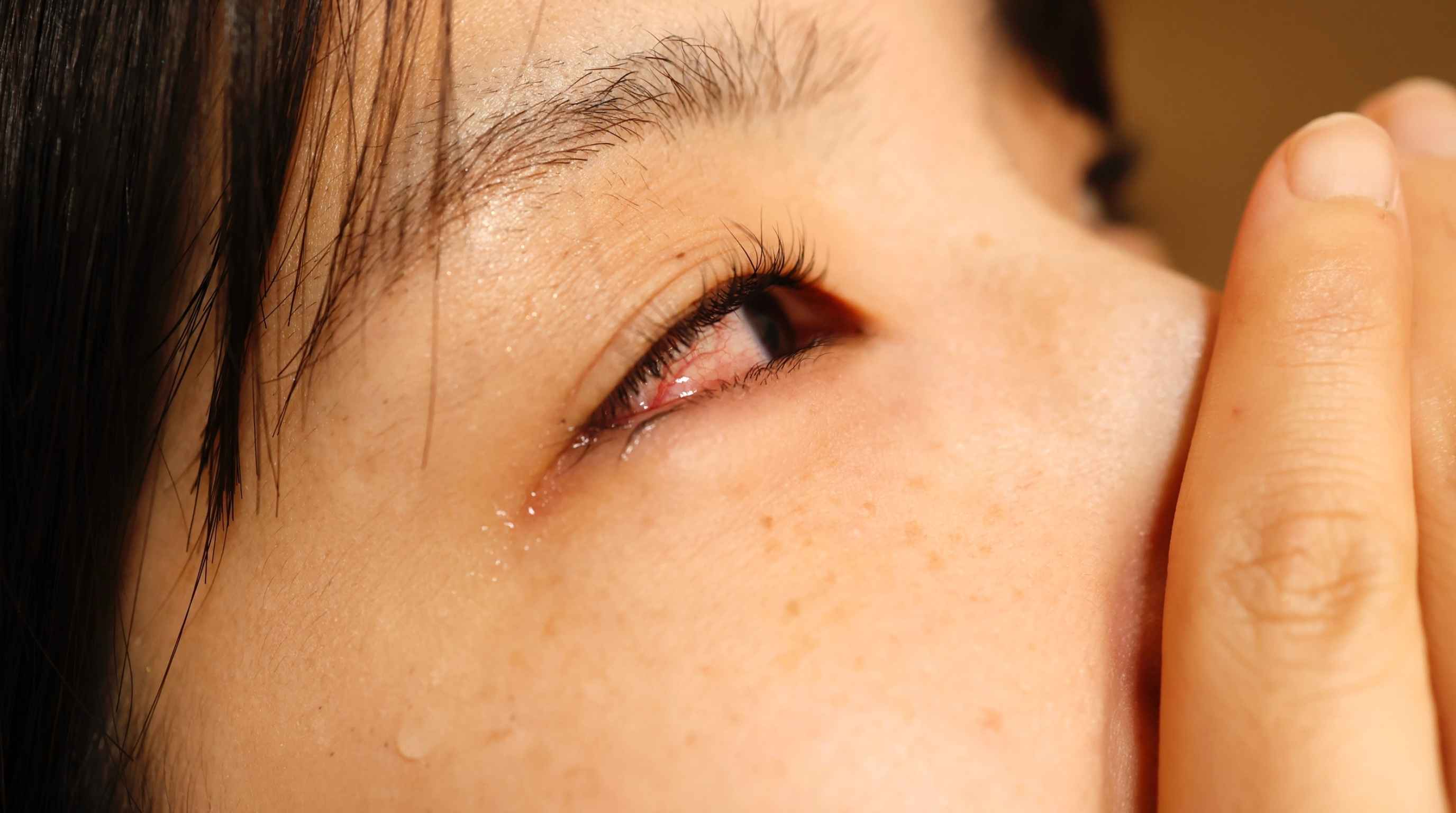  Thick Eye Discharge: How to Tell Pink Eye from Gonorrhea