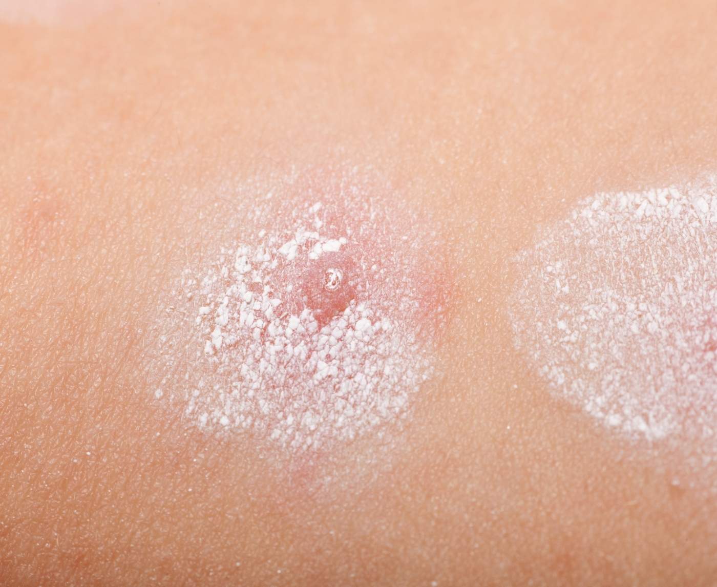 Genital Herpes vs. Ingrown Hair: How to Tell the Difference