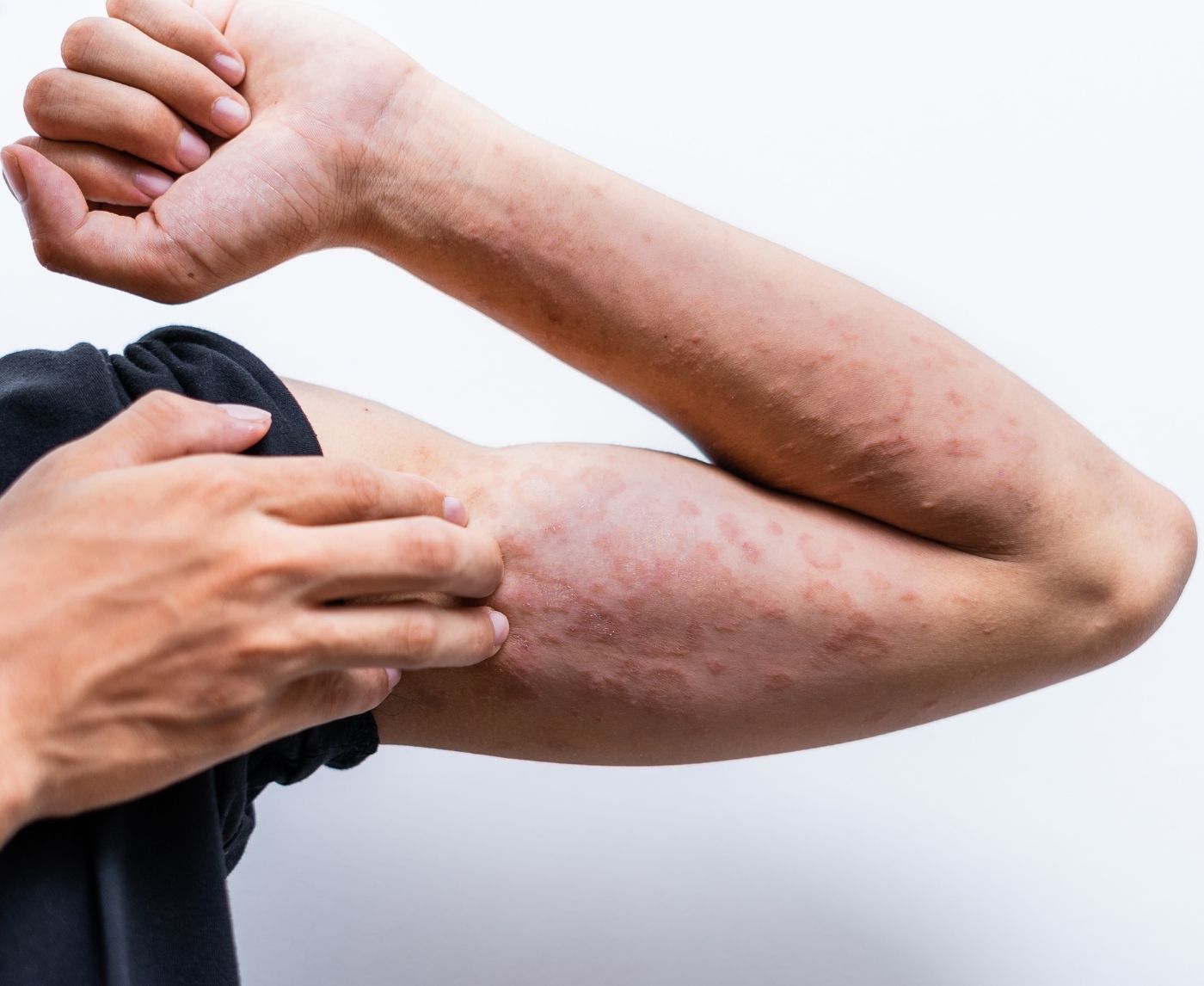 Syphilis in Men: Symptoms & Progression