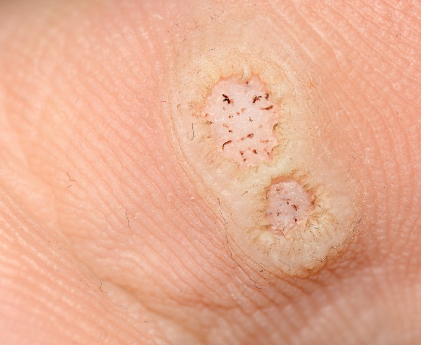Genital Warts: Causes, Symptoms, and Treatment Options for This Common STD