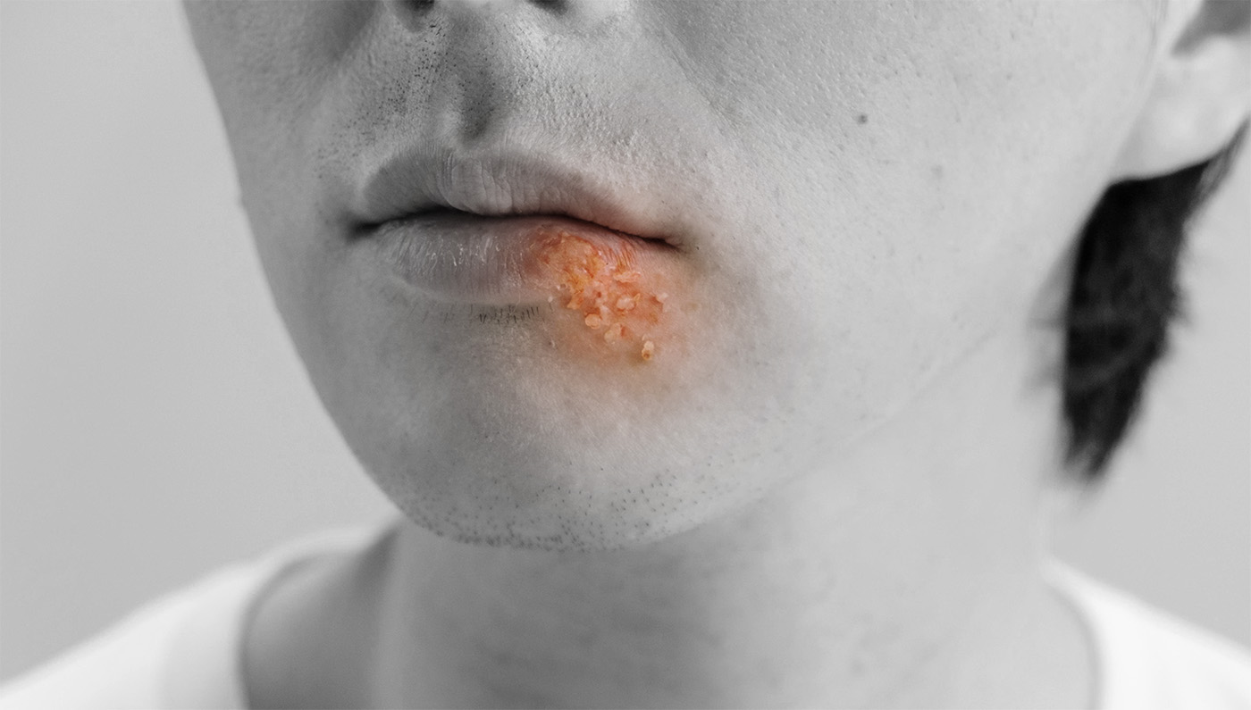 What Kind Of Herpes Does Nba Have What Does Herpes Look Like? Symptoms and Visual Guide