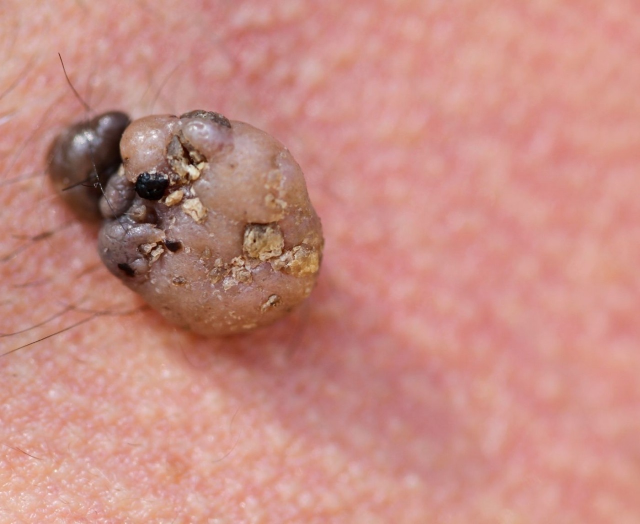 Yes, Genital Warts Can Come Back