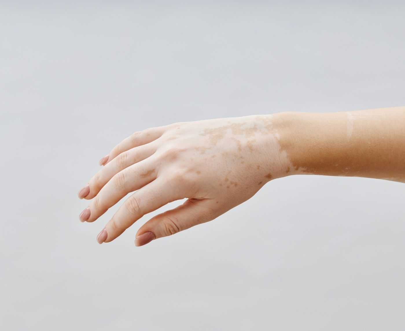 Are White Patches a Fungal Infection or Something More Serious?