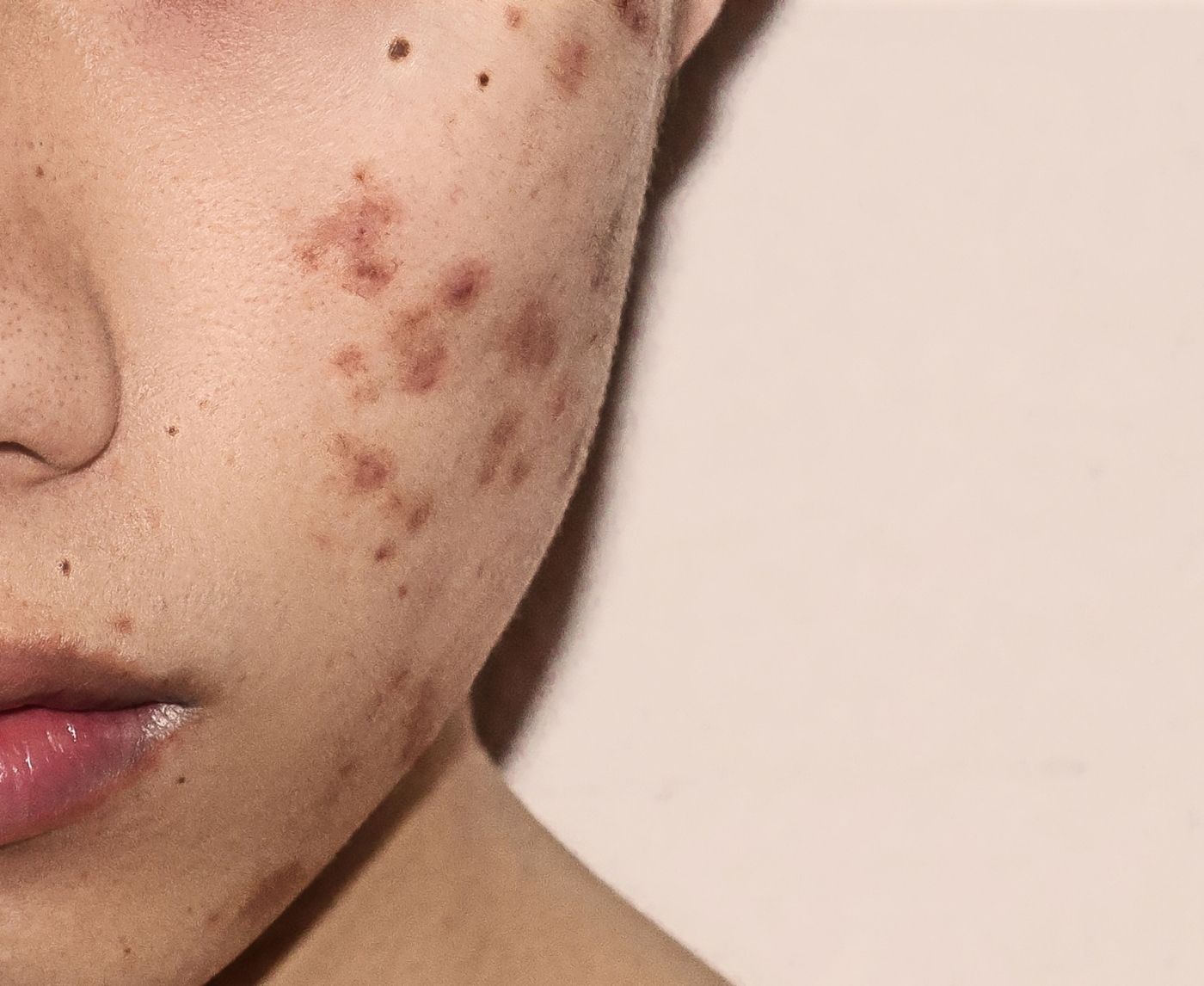 You Might Be Mistaking Herpes for Acne, Here’s How to Tell