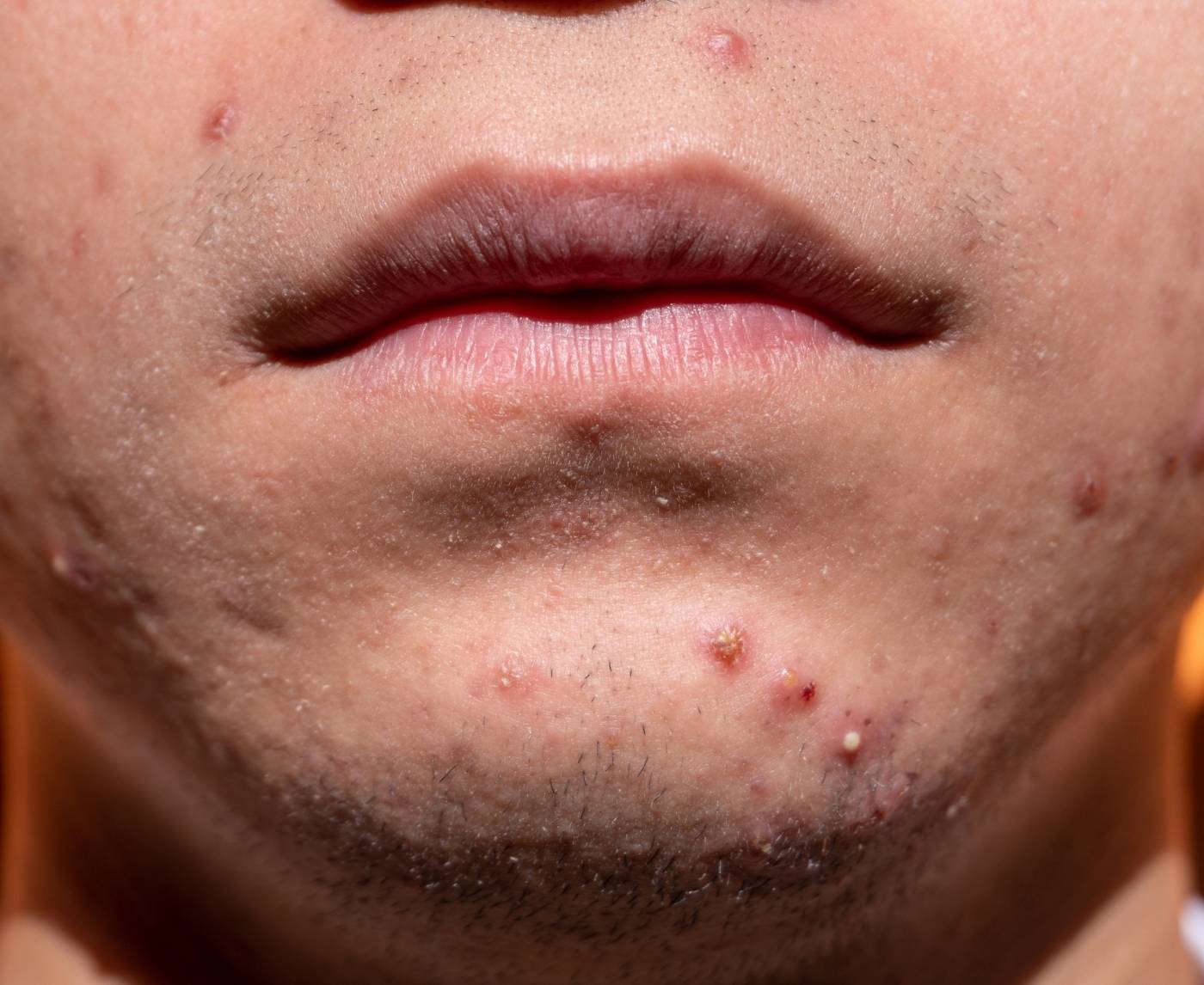 Herpes vs Acne: What That Facial Bump Really Means