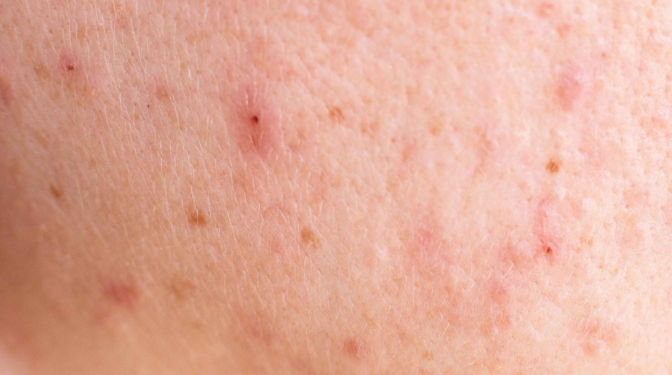 Acne or STD Rash on the Face? What Your Skin Is Trying to Tell You