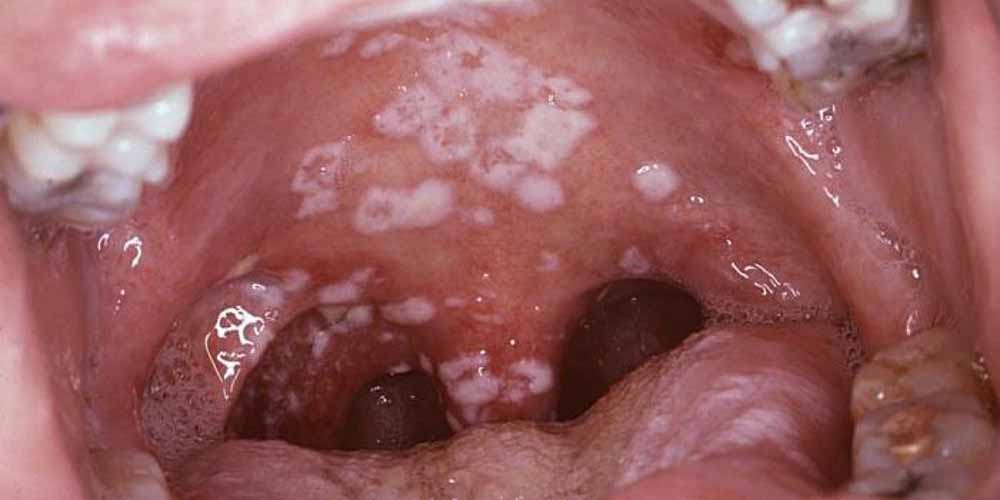 Chlamydia in the mouth - Oral Chlamydia