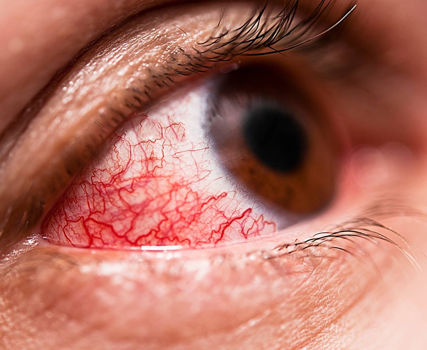 Swollen Eye After Oral Sex? It Could Be Chlamydia