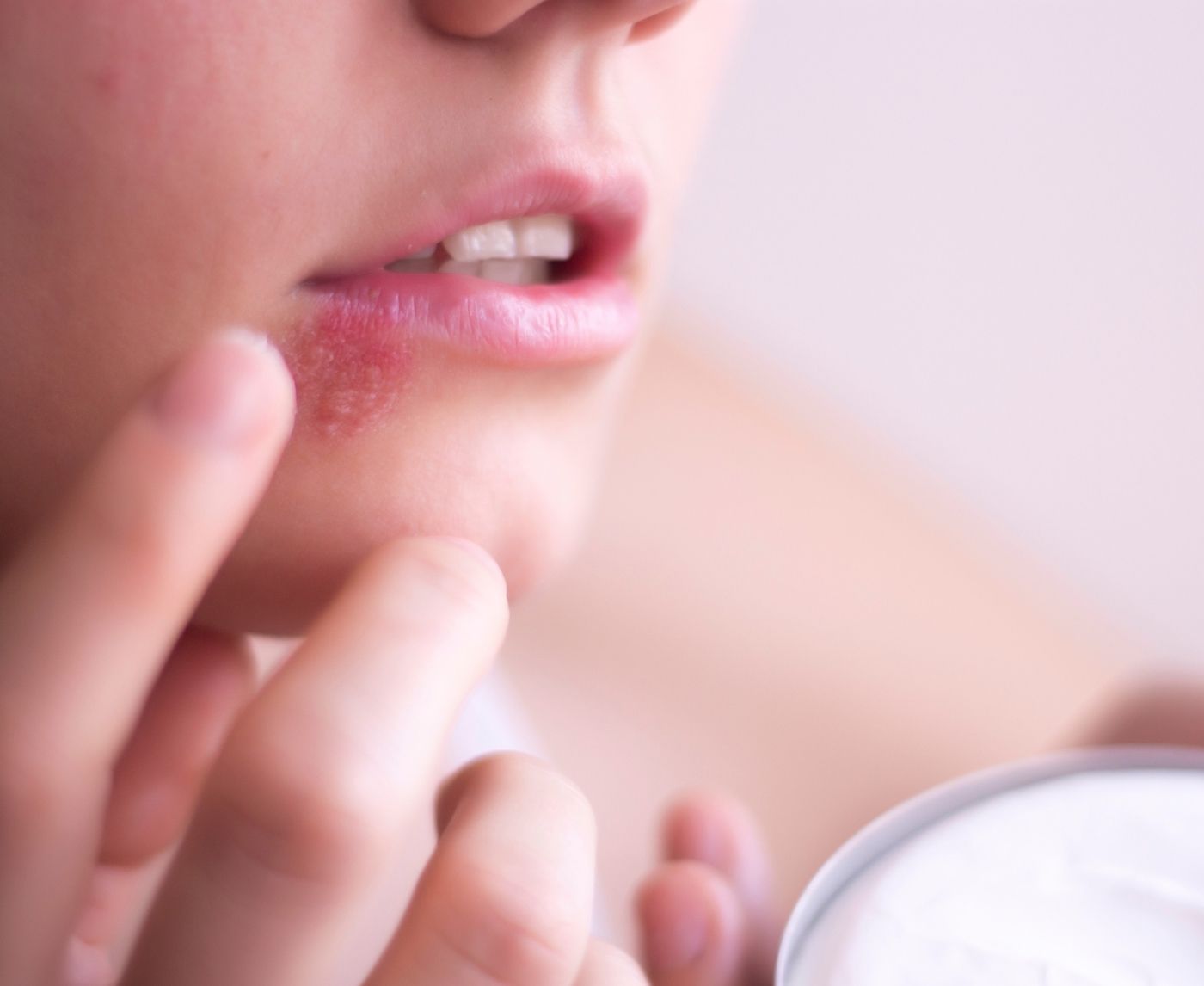 Facial Herpes Is Real, And It Doesn’t Always Stay on the Lips