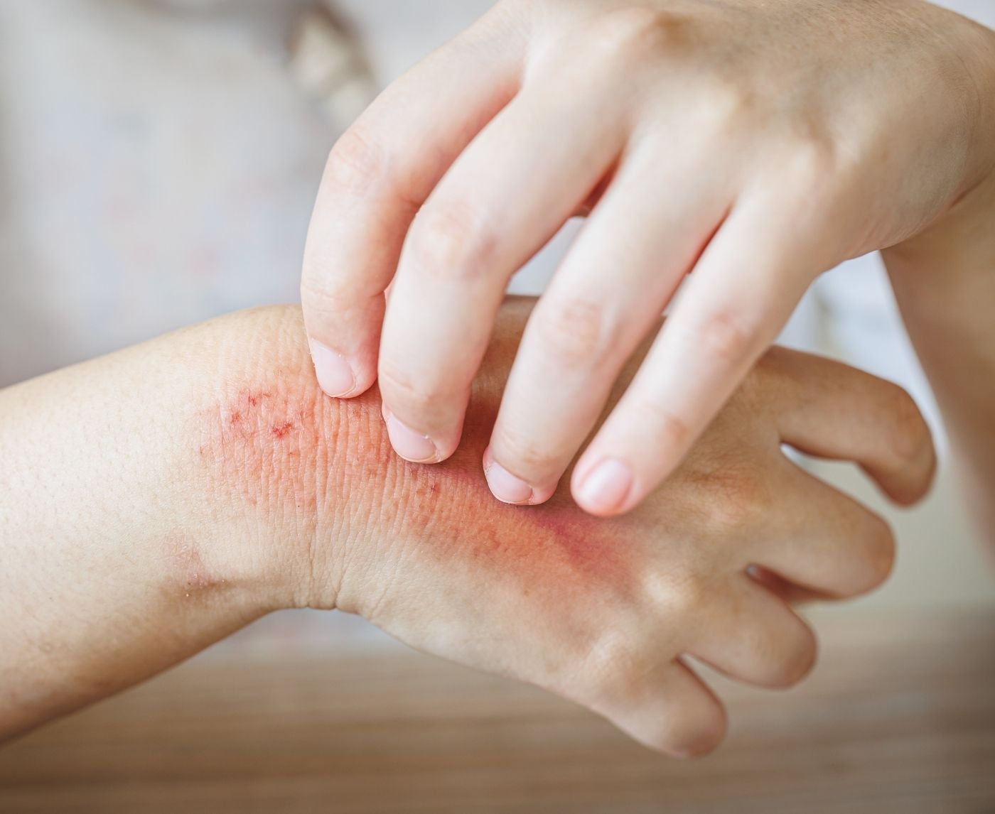 Heat Rash or Herpes? How to Tell the Difference Fast