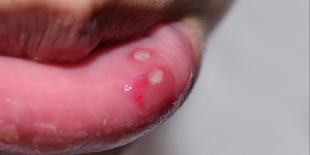 First Week with Herpes: Shame, Shock, and Still No Cure