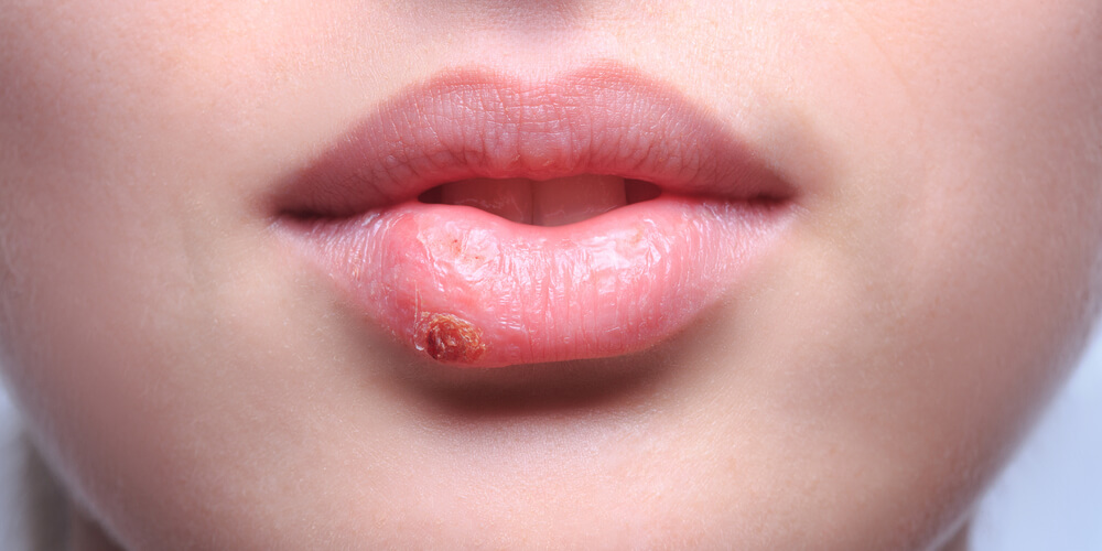 Do You Have Herpes Without Knowing It?